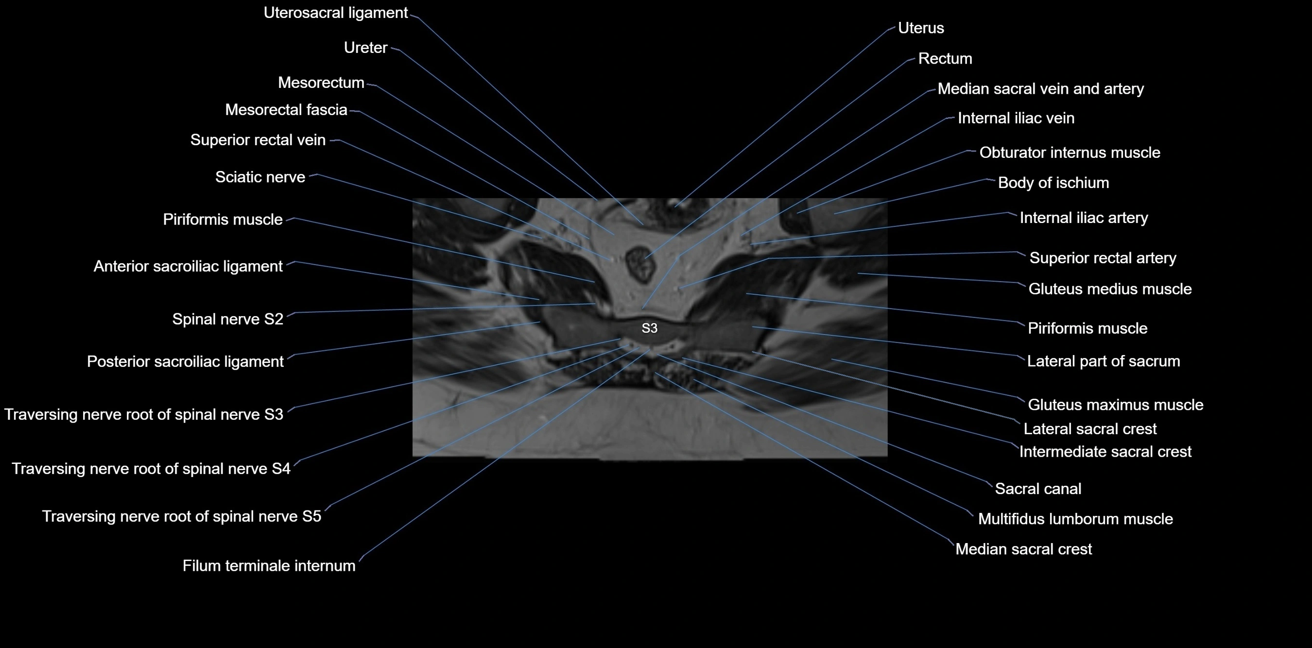MRI sacrum, coccyx and sacroiliac joint axial cross sectional anatomy 3T  radiology  image-img-00001-00039.webp